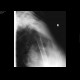 Luxation of the shoulder, caudal, axillary: X-ray - Plain radiograph